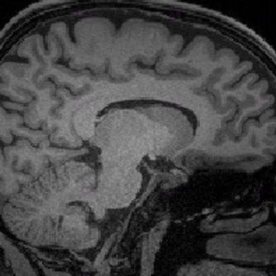 MRI scan of human brain